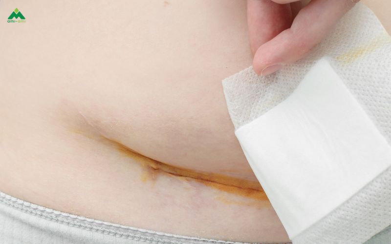 Khi nào thì nên xông hơi vùng kín sau sinh?