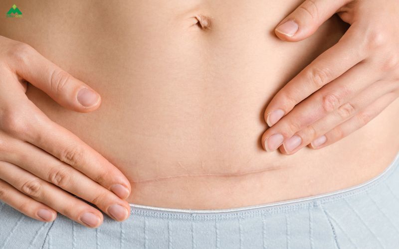 Vết mổ sau sinh – Giai đoạn nào nên cẩn trọng?