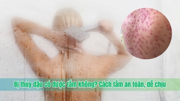 Bị thủy đậu có được tắm không? Cách tắm an toàn, dễ chịu
