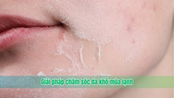 Giải pháp chăm sóc da khô mùa lạnh
