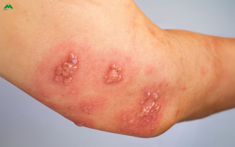 Hiểu về bệnh ghẻ – nguyên nhân và triệu chứng