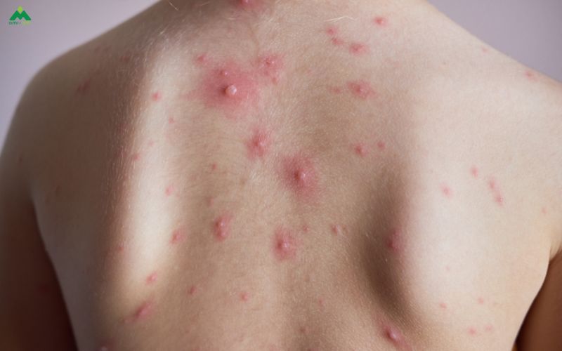 Vì sao nhiều người sợ tắm khi bị thủy đậu?