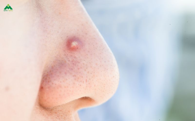Bị mụn viêm có nên xông mặt không?