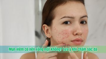 Mụn viêm có nên xông mặt không? Lưu ý khi chăm sóc da