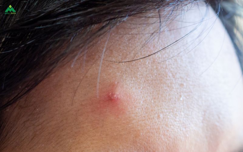 Mụn viêm là gì và đặc điểm nhận biết?