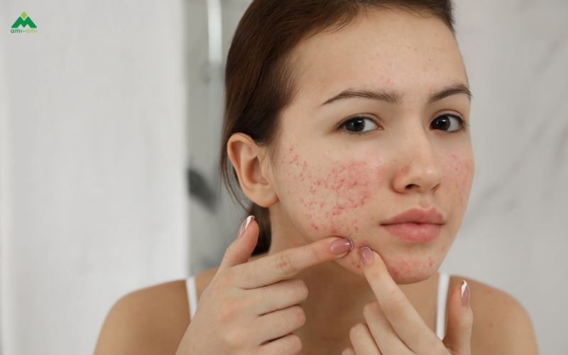 Da nhạy cảm hoặc sau khi nặn mụn có nên xông không?