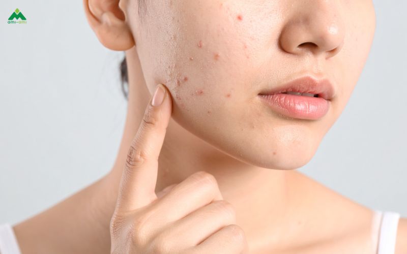 Xông mặt bằng lá kinh giới có giúp trị mụn không?