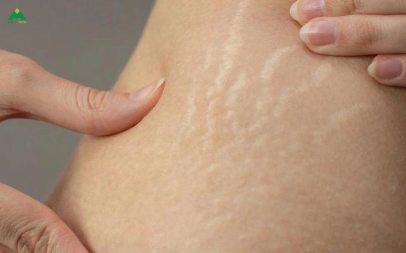 Dấu hiệu nhận biết rạn da sau sinh