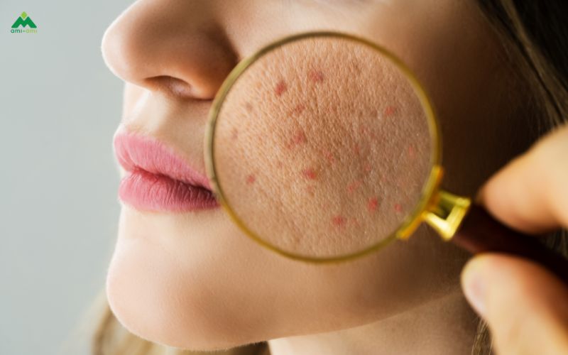 Lợi ích của việc xông mặt bằng lá trà xanh