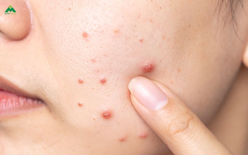 Lợi ích khi xông mặt bằng lá tía tô