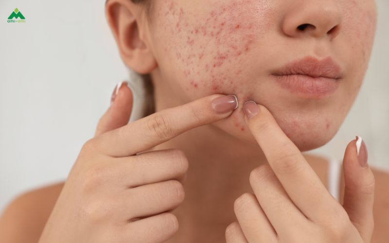Tại sao xông mặt lại lên mụn?