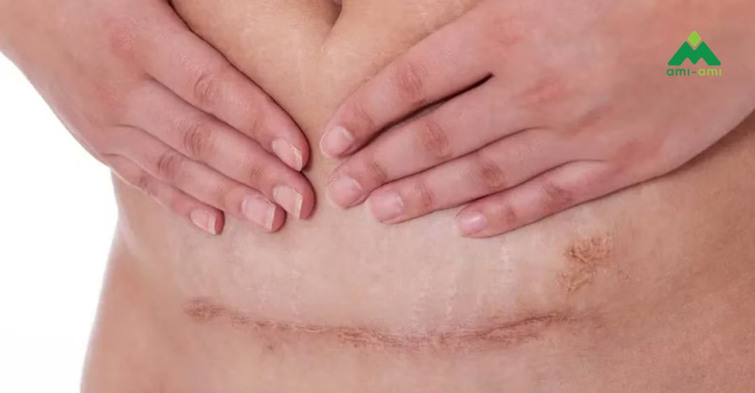 Sinh mổ bao lâu thì xông hơi được để đảm bảo an toàn?