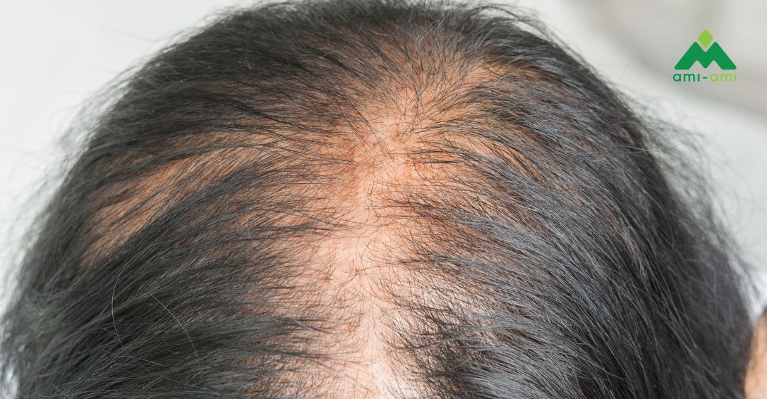 Chẩn đoán tình trạng rụng tóc sau sinh
