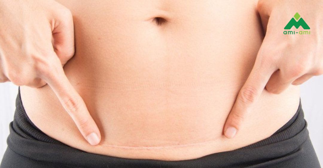 Chăm sóc vết mổ sau sinh và sau cắt chỉ 5 Những lưu ý khi chăm sóc vết mổ sau sinh