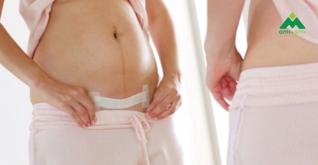 Chăm sóc vết mổ sau sinh và sau cắt chỉ 2 Vì sao cần chăm sóc vết mổ sau sinh đúng cách?