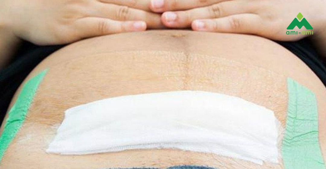 Chăm sóc vết mổ sau sinh và sau cắt chỉ 3 Cách chăm sóc và vệ sinh vết mổ sau sinh tại nhà