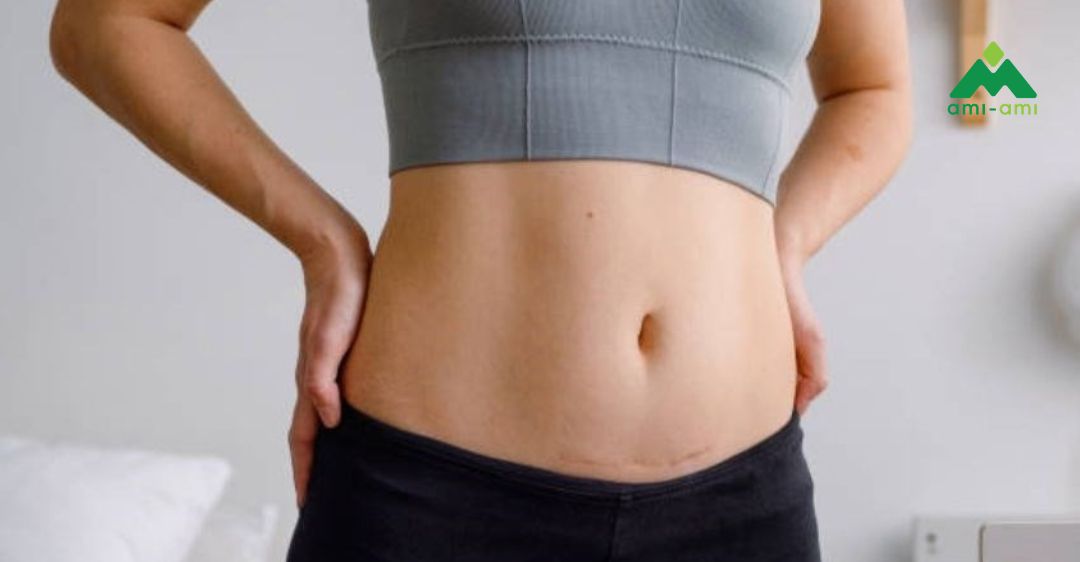 Chăm sóc vết mổ sau sinh và sau cắt chỉ 6 Mẹ nên ăn gì để nhanh chóng hồi phục vết thương?