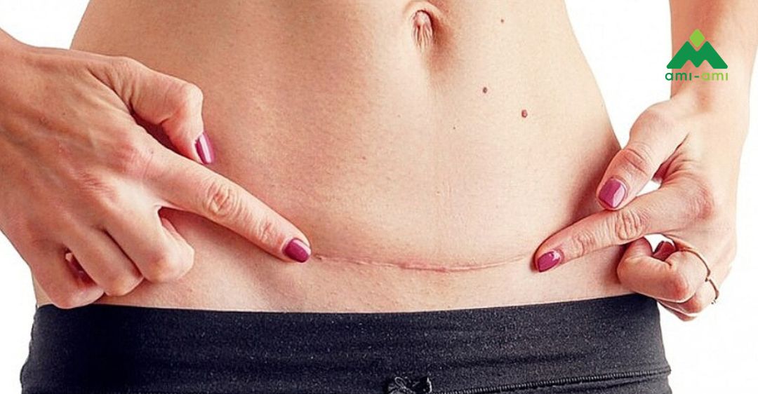 Chăm sóc vết mổ sau sinh và sau cắt chỉ 4 Chăm sóc vết mổ sau sinh theo từng giai đoạn