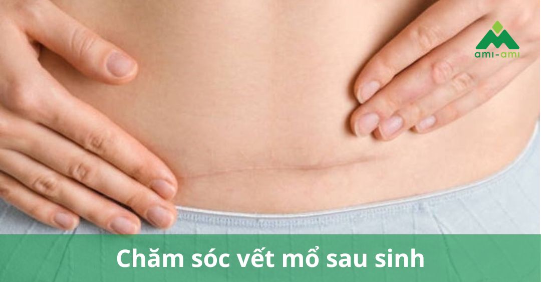 Chăm sóc vết mổ sau sinh và sau cắt chỉ